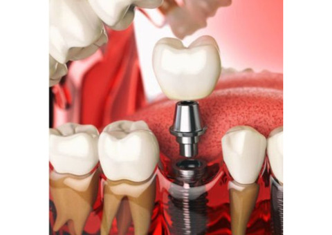 Get a Dental Implant Treatment in Kolkata Done by the Best Surgeon