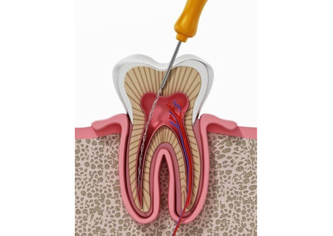 Top Rated Root Canal in Kandivali with Quality Care