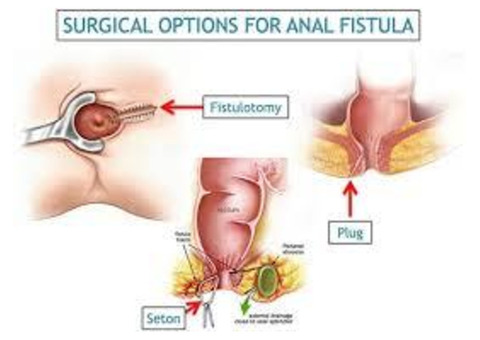 Best Doctor For Fistula Treatment in Indirapuram