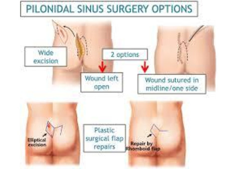 Pilonidal Sinus treatment in Ghaziabad