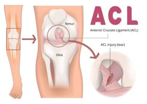 Expert ACL Ligament Surgery in Bihar for Faster Recovery