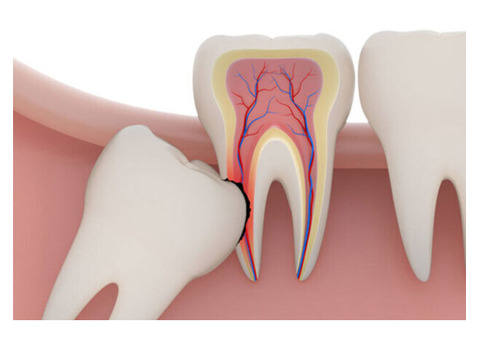 Dental Implant Cost Canberra