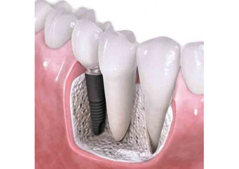 How Much A Dental Implant Cost In Mayur Vihar?