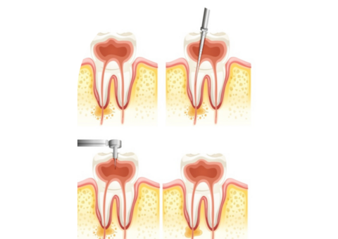 Oral Health Care Tips To Follow After Root Canal Treatment In Noida