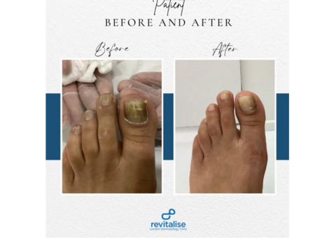 Fungal Nail Infections Treatment - Nail Fungus Treatment London