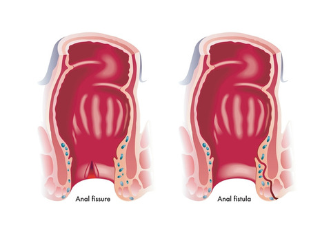 Best Ayurvedic Anal Fistula Treatment in Ghaziabad