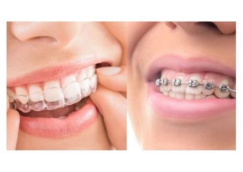 Get a Perfect Smile with Aligners In Mumbai at Aligner Point