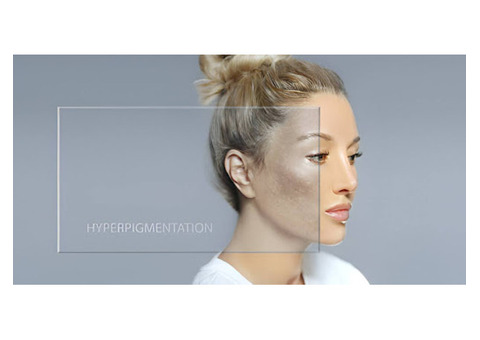 What Are the Types of Pigmentation and Their Treatments?