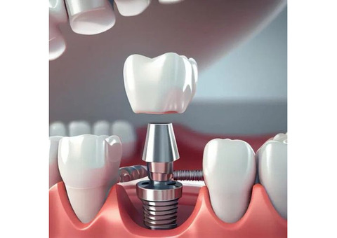 Restore Your Smile with Expert Dental Implants in Kandivali