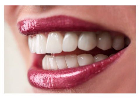 Perfect Your Smile with Porcelain Veneers in Miami!