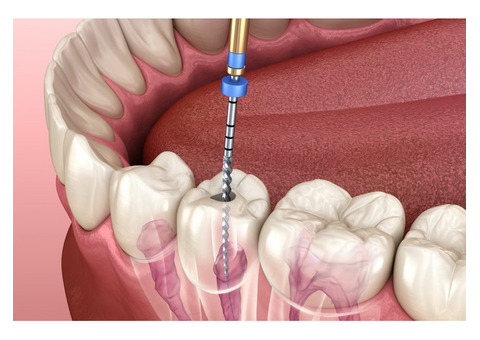 Root Canal Prices: Cost Breakdown & Affordable Options