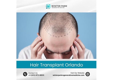 Hair Transplant Orlando – Restore Your Confidence Today!