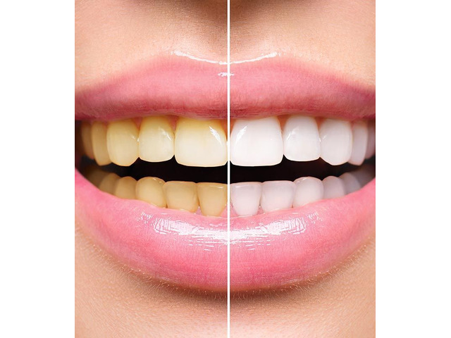 Brighten Your Smile with Teeth Whitening Treatment in IC Colony Brighten Your Smile with Teeth Whitening Treatment in IC Colony