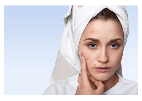 Best acne treatment Bilaspur 2025 | Saluja skin clinic
