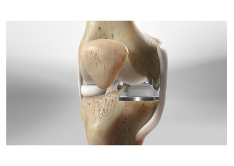 Get Back On Your Feet With Partial Knee Replacement Surgery
