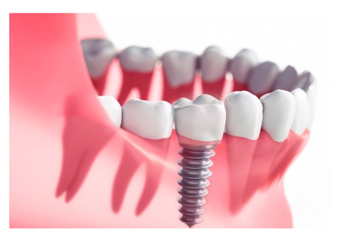 Restore Your Smile with Dental Implants in Boronia