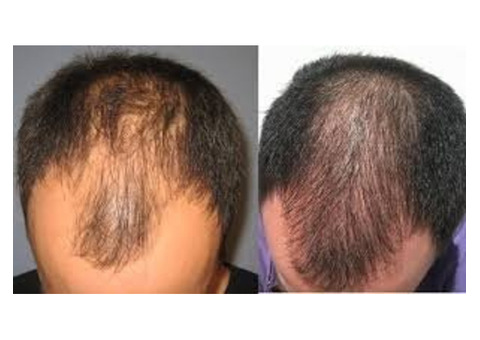 PRP Hair Loss Treatment