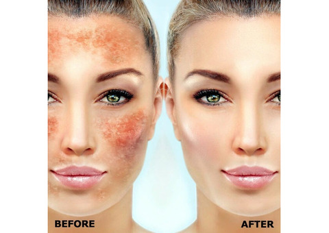 Effective Pigmentation Treatment in Delhi for Radiant Results
