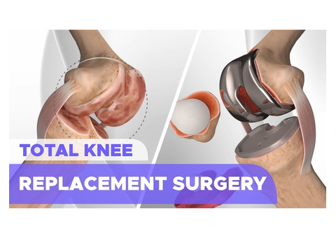 Get Moving Again: Total Knee Replacement Surgery in Delhi