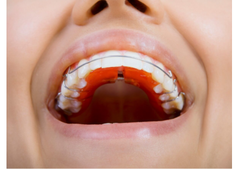 Plastic Retainers for Teeth | Pesh Orthodontics