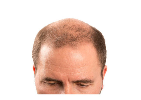 Current and Emerging Treatment for Androgenetic Alopecia