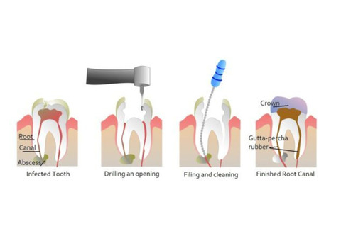 How to Find the Right Dentist for Root Canal Treatment in Thane