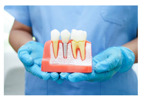 Why Dental Implants Are the Best Solution for Missing Teeth