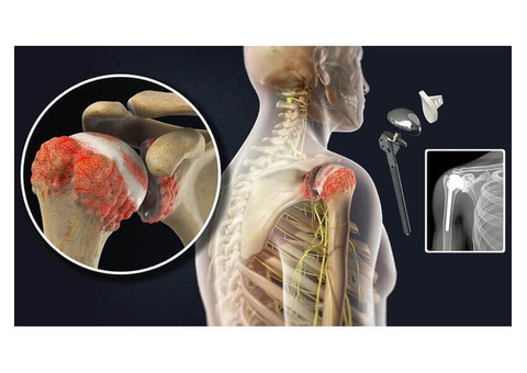 Regain Shoulder Strength with Total Shoulder Replacement Delhi