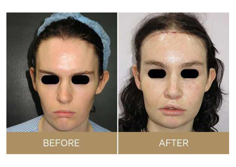 Transgender Facial Feminization Surgery in India
